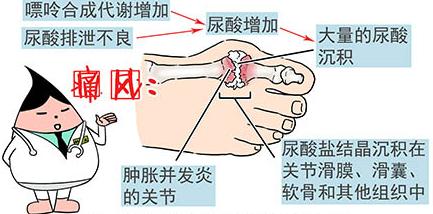 痛风不能吃哪些东西