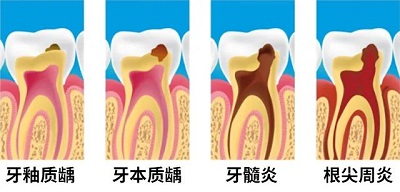 治疗牙髓炎大概需要多久