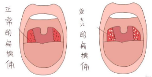 扁桃体发炎症状表现是什么