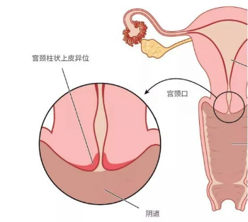 男人怎么知道顶到宫颈了