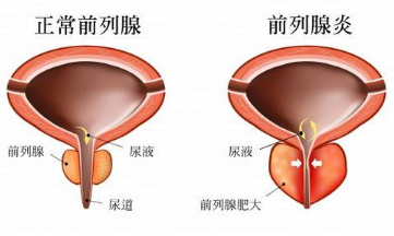 前列腺炎最好的药 