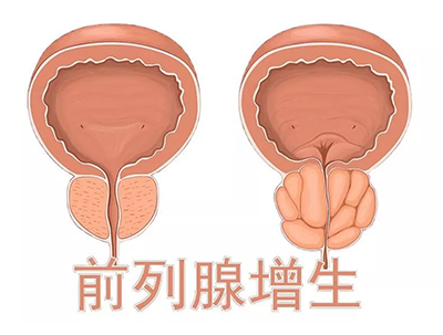 前列腺增生吃他达拉非有效果吗