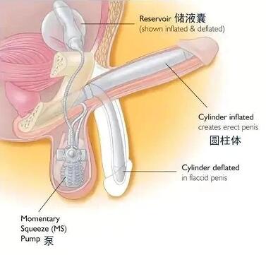 男性植入假体是什么原理