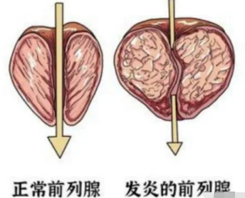 因为前列腺炎引起早些泄能治好吗