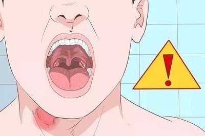 喉咙痛吞咽有异物感怎么回事