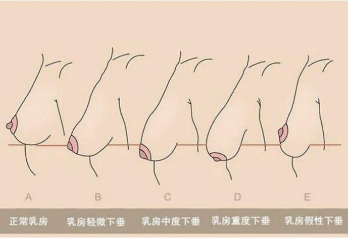 胸下垂怎么办怎么解决方法