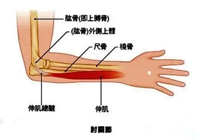 腱鞘炎是怎么引起的,怎么治疗最好